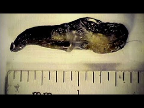 FULL Documentary on Alien Implants Pt 2 featuring Dr. Roger Leir